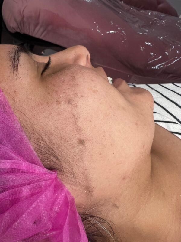 Dermaplaning - Image 2